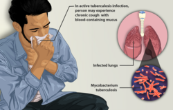Depiction of a tuberculosis patient.png